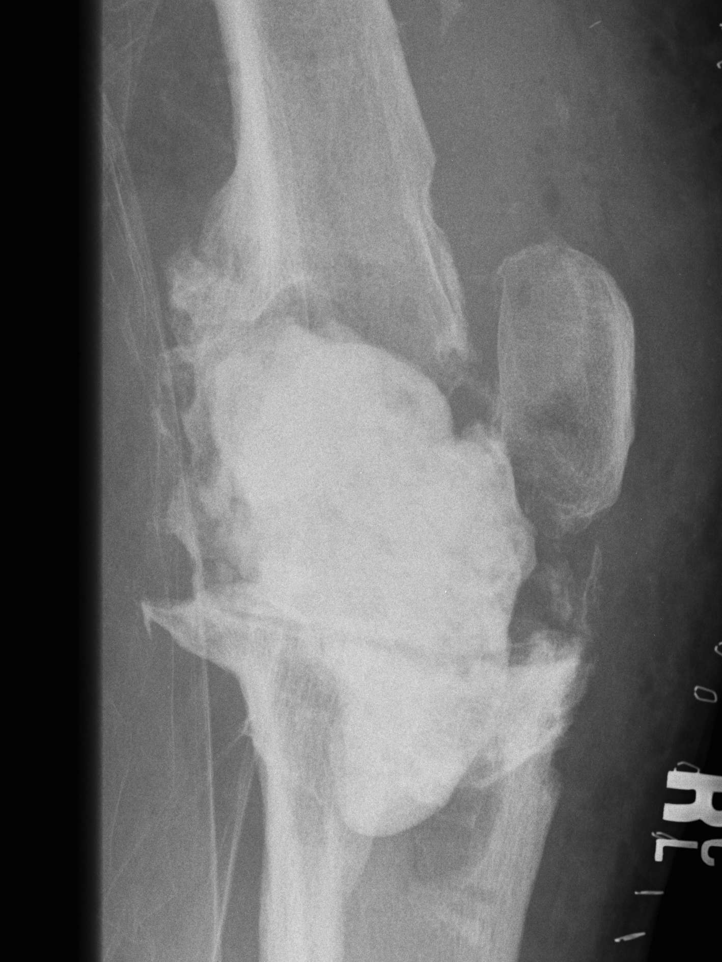Infected TKR Cement Ball Bone Loss Lateral